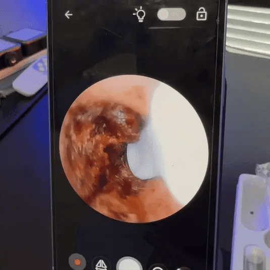 20 lat nagromadzonej woskowiny usznej