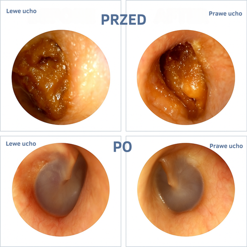 WaxClean™ – Inteligentne czyszczenie uszu z zaawansowaną technologią